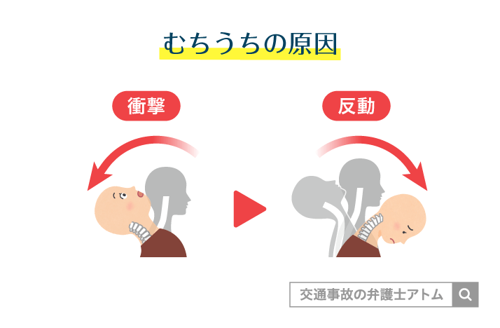 むちうちの原因