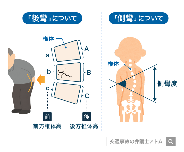 「後彎」について 「側彎」について